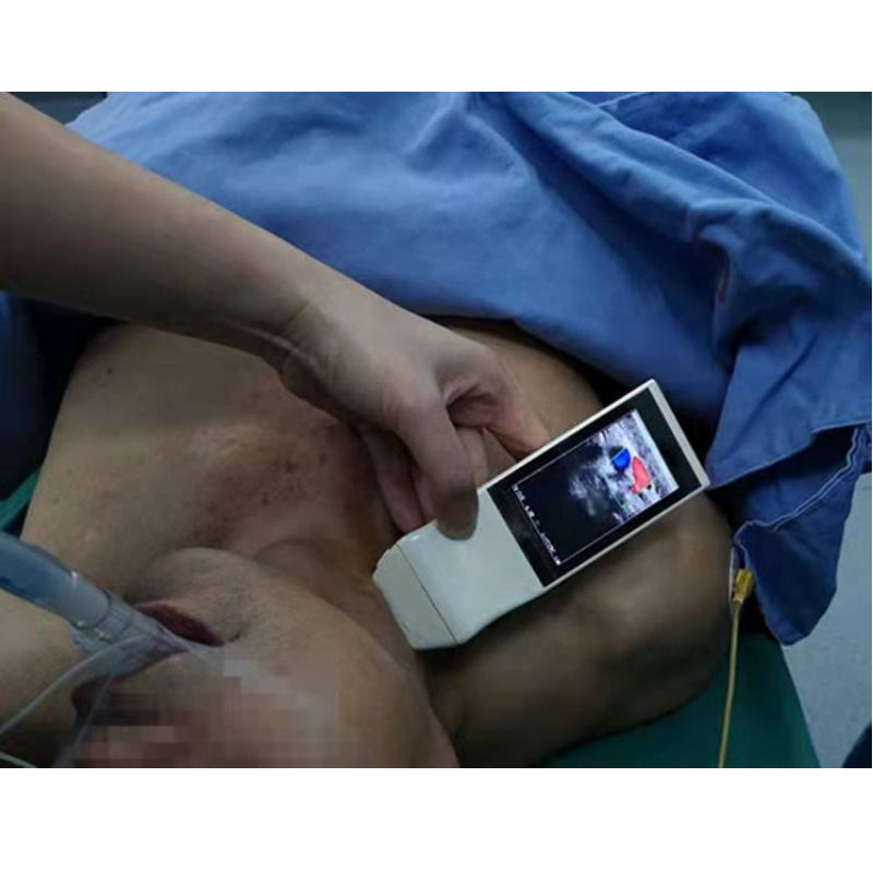 WIFI draadloze kleursonde GYN Ultrasound Lineaire sonde met display Anesthesie Punctie Navigatie Handheld Ultrasound
